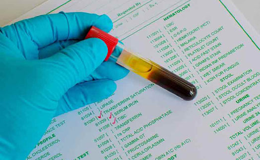A blood sample with a laboratory request form for a patient suffering Iron deficiency anemia-IDA basic tests including transferrin saturation, serum iron and TIBC are requested.